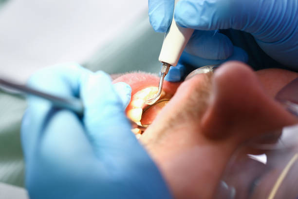 Best Dental Abscess Treatment in Dundalk, MD